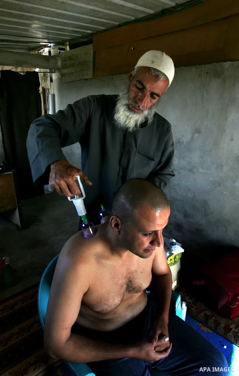 Palestinian therapist Rabhy Abu Jazar treats a patient suffering from backache and headaches using a form of cupping therapy which extracts blood from the patient, at his clinic in the Rafah refugee camp, southern Gaza S...