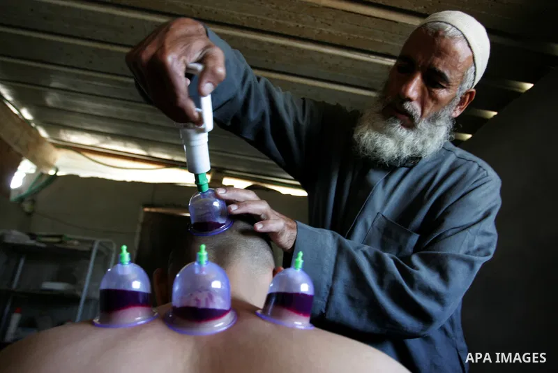 Palestinian therapist Rabhy Abu Jazar treats a patient suffering from backache and headaches using a form of cupping therapy which extracts blood from the patient, at his clinic in the Rafah refugee camp, southern Gaza S...
