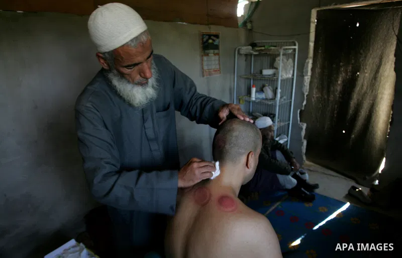 Palestinian therapist Rabhy Abu Jazar treats a patient suffering from backache and headaches using a form of cupping therapy which extracts blood from the patient, at his clinic in the Rafah refugee camp, southern Gaza S...
