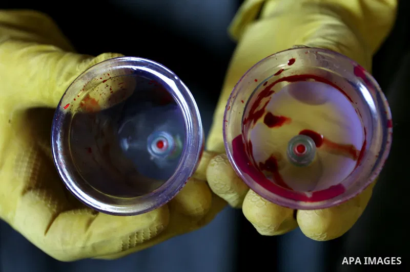 Palestinian therapist Rabhy Abu Jazar treats a patient suffering from backache and headaches using a form of cupping therapy which extracts blood from the patient, at his clinic in the Rafah refugee camp, southern Gaza S...