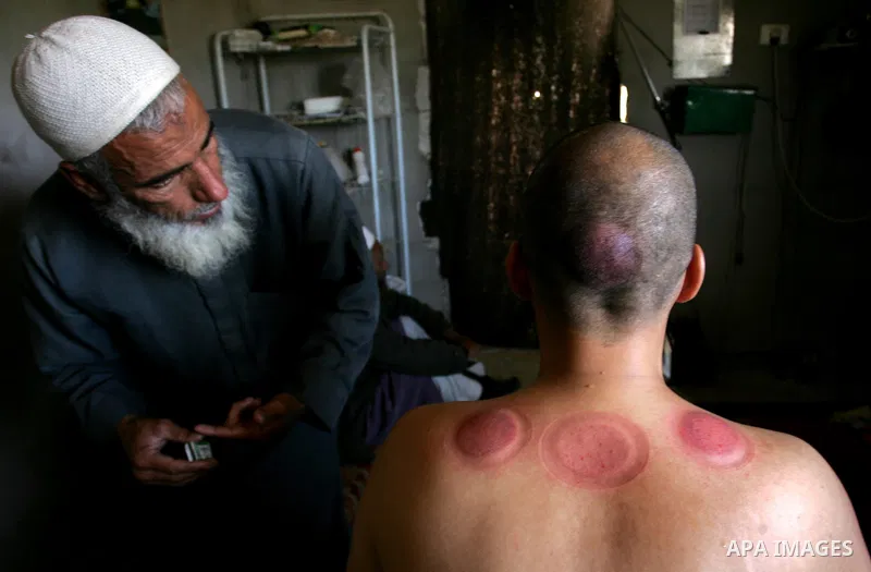 Palestinian therapist Rabhy Abu Jazar treats a patient suffering from backache and headaches using a form of cupping therapy which extracts blood from the patient, at his clinic in the Rafah refugee camp, southern Gaza S...