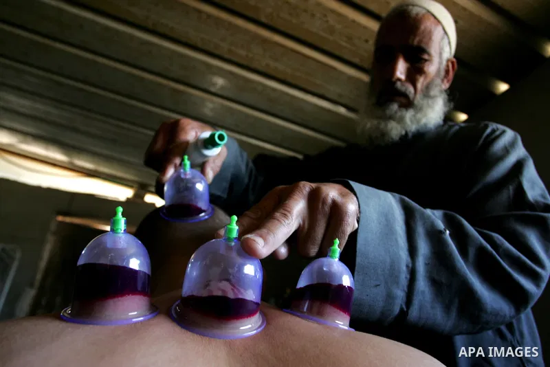 Palestinian therapist Rabhy Abu Jazar treats a patient suffering from backache and headaches using a form of cupping therapy which extracts blood from the patient, at his clinic in the Rafah refugee camp, southern Gaza S...