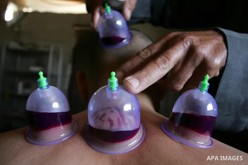 Palestinian therapist Rabhy Abu Jazar treats a patient suffering from backache and headaches using a form of cupping therapy which extracts blood from the patient, at his clinic in the Rafah refugee camp, southern Gaza S...