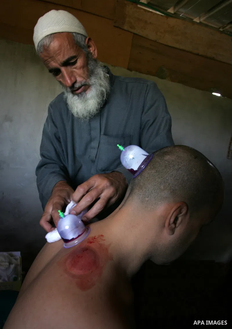 Palestinian therapist Rabhy Abu Jazar treats a patient suffering from backache and headaches using a form of cupping therapy which extracts blood from the patient, at his clinic in the Rafah refugee camp, southern Gaza S...