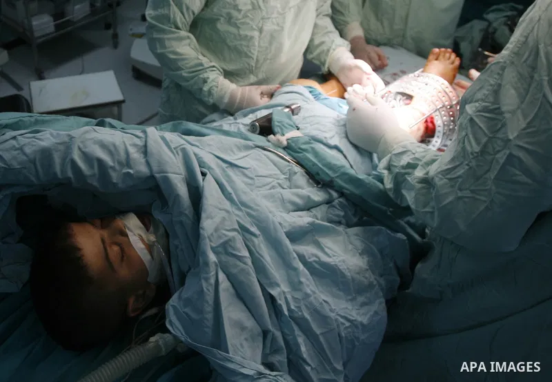 Palestinian doctors perform the first surgery to lengthen a child, "dwarf" in Abu Yousef Al Najjar hospital in Rafah city in the southern Gaza Strip, on April,15, 2012. Photo by Eyad Al Baba