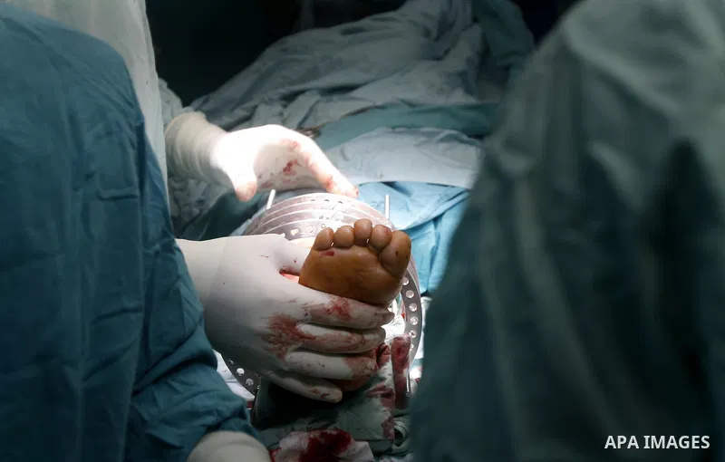 Palestinian doctors perform the first surgery to lengthen a child, "dwarf" in Abu Yousef Al Najjar hospital in Rafah city in the southern Gaza Strip, on April,15, 2012. Photo by Eyad Al Baba