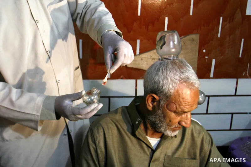Anwar Sheikh-Eid, 42, performs Hijama or cupping therapy, to Palestinian patient Musa Sheikh El Eid at his shop in the southern Gaza Strip city of Rafah on 27 June 2012. Cupping is an ancient form of alternative medicine...