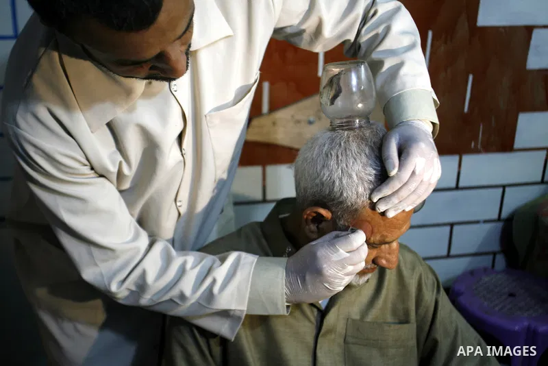 Anwar Sheikh-Eid, 42, performs Hijama or cupping therapy, to Palestinian patient Musa Sheikh El Eid at his shop in the southern Gaza Strip city of Rafah on 27 June 2012. Cupping is an ancient form of alternative medicine...