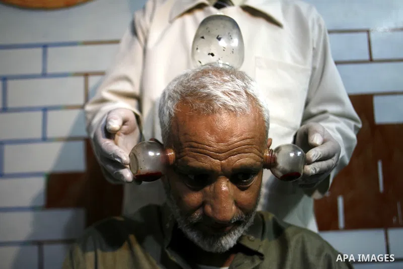 Anwar Sheikh-Eid, 42, performs Hijama or cupping therapy, to Palestinian patient Musa Sheikh El Eid at his shop in the southern Gaza Strip city of Rafah on 27 June 2012. Cupping is an ancient form of alternative medicine...