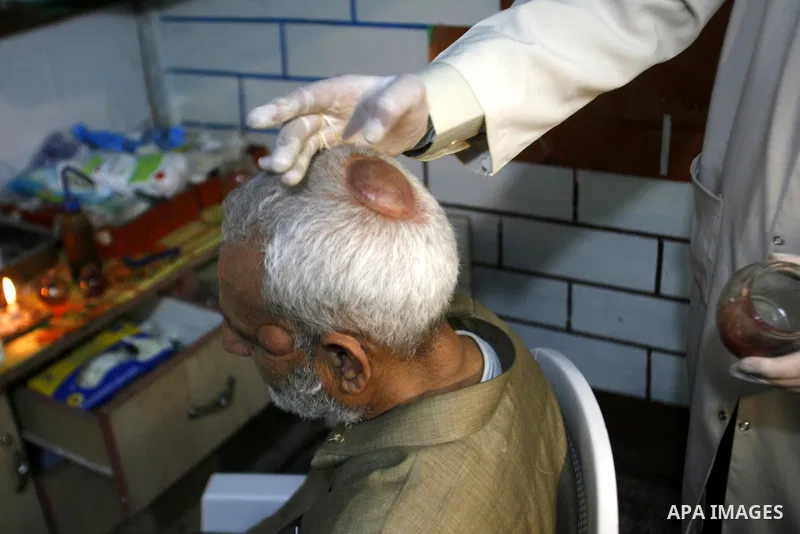 Anwar Sheikh-Eid, 42, performs Hijama or cupping therapy, to Palestinian patient Musa Sheikh El Eid at his shop in the southern Gaza Strip city of Rafah on 27 June 2012. Cupping is an ancient form of alternative medicine...