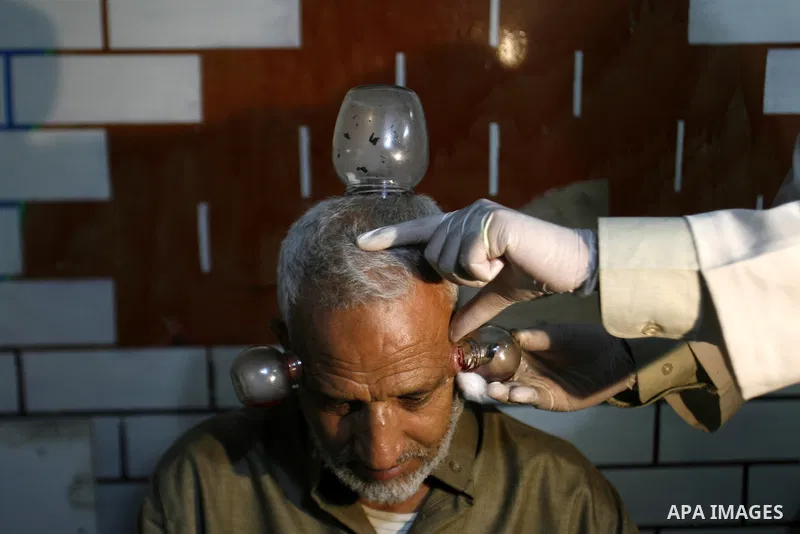 Anwar Sheikh-Eid, 42, performs Hijama or cupping therapy, to Palestinian patient Musa Sheikh El Eid at his shop in the southern Gaza Strip city of Rafah on 27 June 2012. Cupping is an ancient form of alternative medicine...