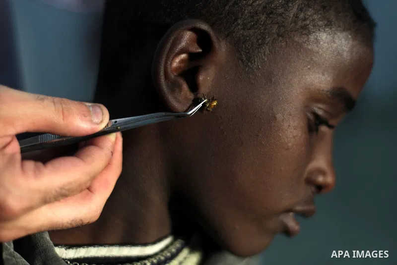 A Palestinian boy is treated by the use of a bee sting at the clinic of Alaa Abu Ghali, a Palestinian specialized physiotherapy turned healer, on April 24, 2013 in the southern Gaza Strip city of Rafah. Ghali uses the be...
