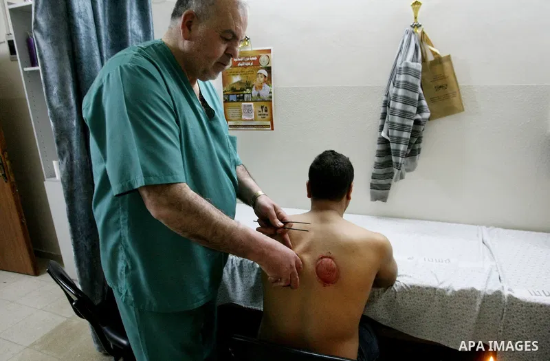 Palestinian doctor Asem al-Tamimi treats patients by traditional cupping at his clinic in the West Bank city of Hebron, May 01, 2013. Negative pressures are created inside glass containers, which are inverted and placed...