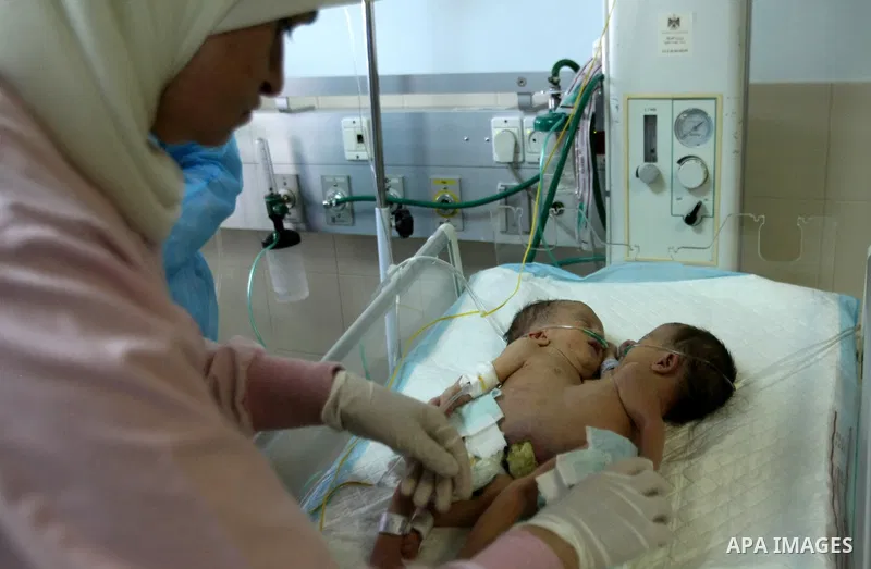 Three-day-old Iman and Amani Palestinian Siamese twin girls from the Breiwesh family lie on a incubator in the newborns unit at the Alia Hospital in the West Bank city of Hebron on June 03, 2013. Their mother received pe...
