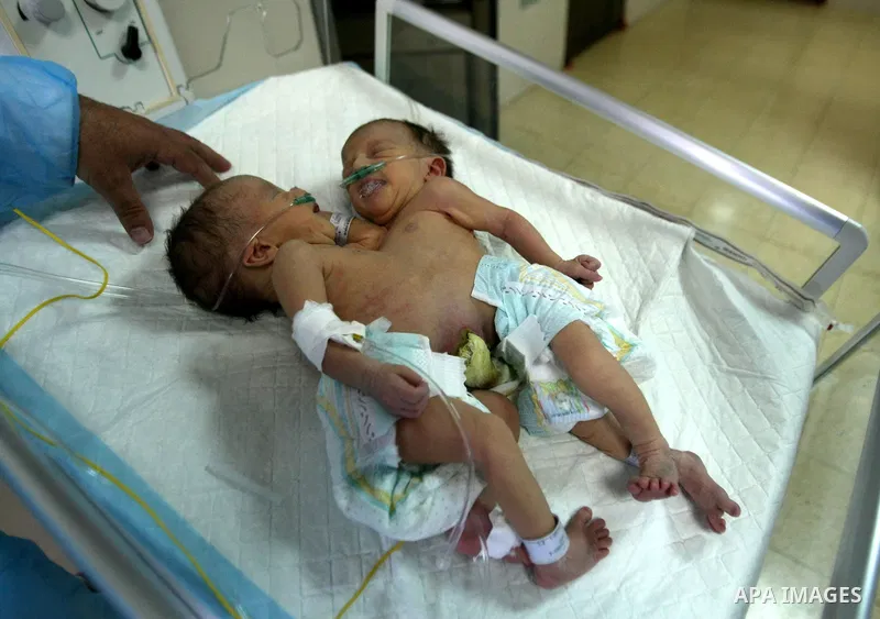 Three-day-old Iman and Amani Palestinian Siamese twin girls from the Breiwesh family lie on a incubator in the newborns unit at the Alia Hospital in the West Bank city of Hebron on June 03, 2013. Their mother received pe...