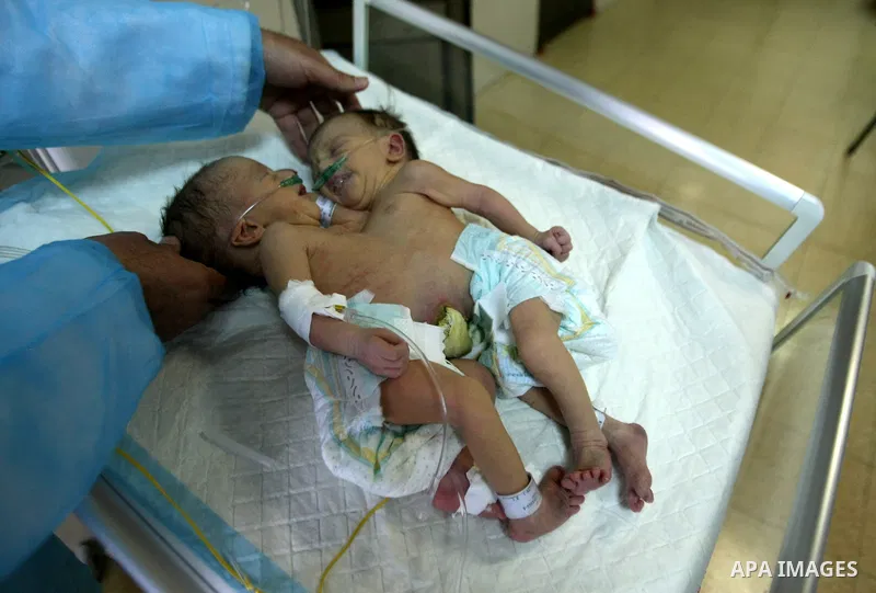 Three-day-old Iman and Amani Palestinian Siamese twin girls from the Breiwesh family lie on a incubator in the newborns unit at the Alia Hospital in the West Bank city of Hebron on June 03, 2013. Their mother received pe...