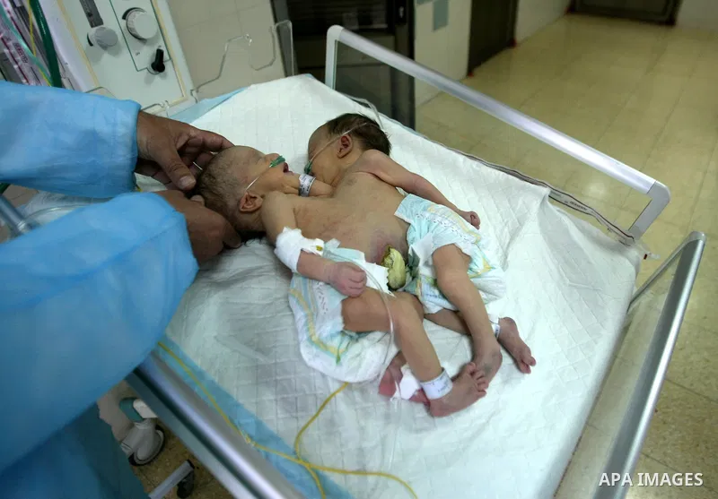 Three-day-old Iman and Amani Palestinian Siamese twin girls from the Breiwesh family lie on a incubator in the newborns unit at the Alia Hospital in the West Bank city of Hebron on June 03, 2013. Their mother received pe...