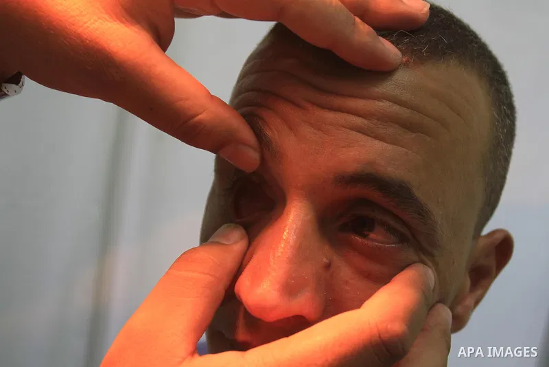 A Palestinian specialist of eye prosthetic examines a lost eye patient his eye at his clinic, in Gaza City on Sept. 10, 2013. The clinic is the first in Gaza which makes the prosthetic eye similar and with same imprint o...