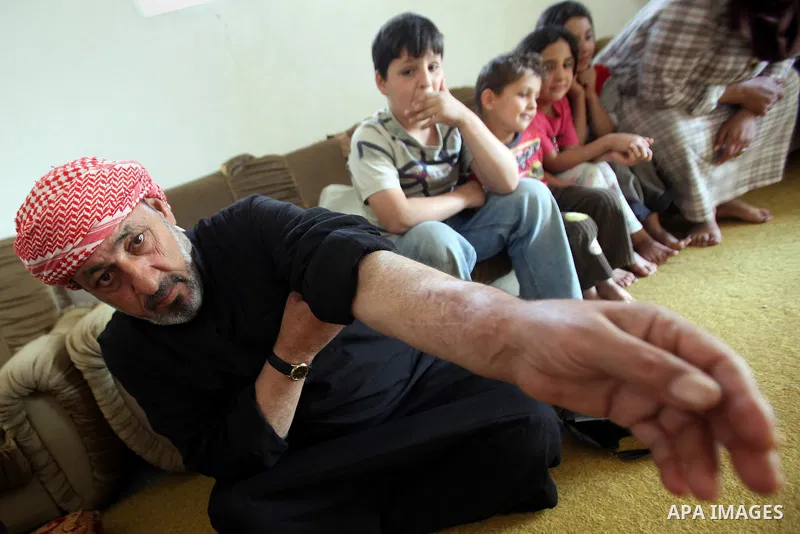 Ahmad Mansour, 54, shows his hand wounds at his house in the village of al-Kitteh western city of Jerash, 50 km northern the Jordanian capital Amman on February 21, 2014 . Mansour arrived on foot on a stretcher as a Syri...
