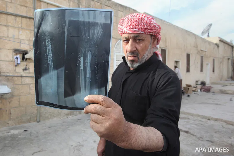 Ahmad Mansour, 54, displays his hand X-rays at his house in the village of al-Kitteh western city of Jerash, 50 km northern the Jordanian capital Amman on February 21, 2014 . Mansour arrived on foot on a stretcher as a S...