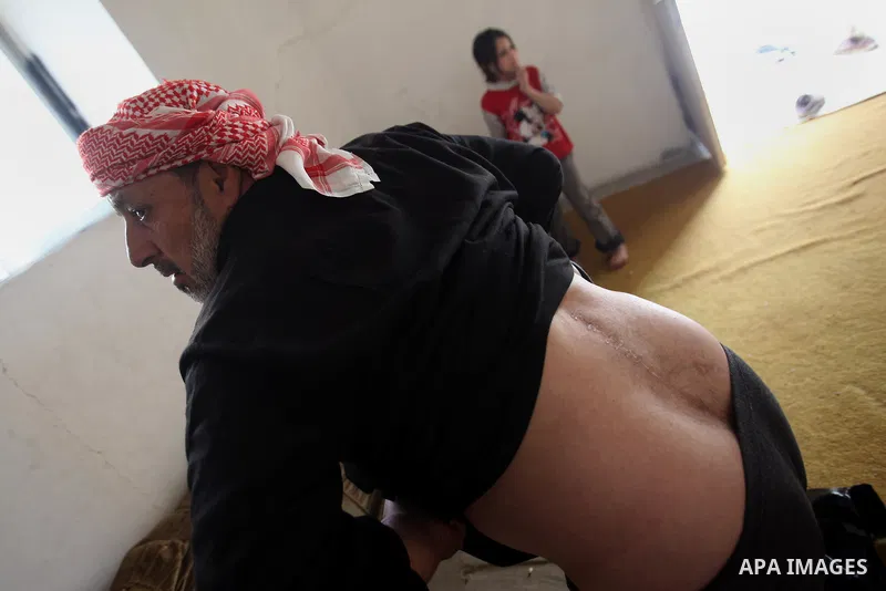 Ahmad Mansour, 54, shows his back wounds at his house in the village of al-Kitteh western city of Jerash, 50 km northern the Jordanian capital Amman on February 21, 2014 . Mansour arrived on foot on a stretcher as a Syri...