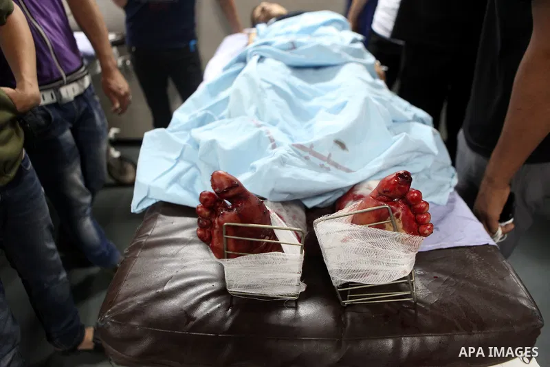 A Palestinian whom medics said was wounded in an Israeli air strike, lies on a bed at a hospital in Gaza City July 8, 2014. At least 14 people were killed in strikes on the Gaza Strip on Tuesday, Palestinian officials sa...