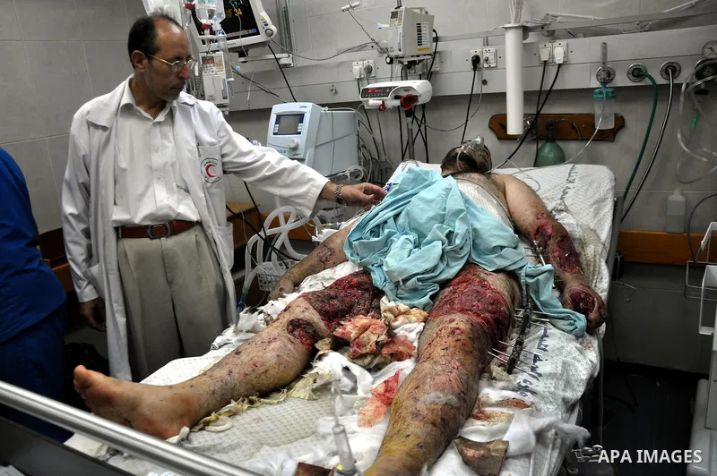 A Palestinian man lies at the intensive care unit in al-Shifa hospital in Gaza City on July 15, 2014. Israel approved an Egyptian-proposed deal that would halt the week-old Gaza shelling war on Tuesday but the Palestinia...