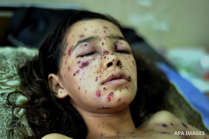 Palestinian Children rests at the Shifa hospital to receiving treatment, in Gaza City, on August 2, 2014. The Israeli army gave a first indication it was ending operations in parts of Gaza, while continuing to bombard ot...