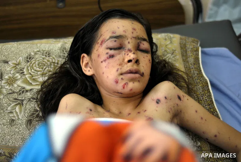 Palestinian Children rests at the Shifa hospital to receiving treatment, in Gaza City, on August 2, 2014. The Israeli army gave a first indication it was ending operations in parts of Gaza, while continuing to bombard ot...