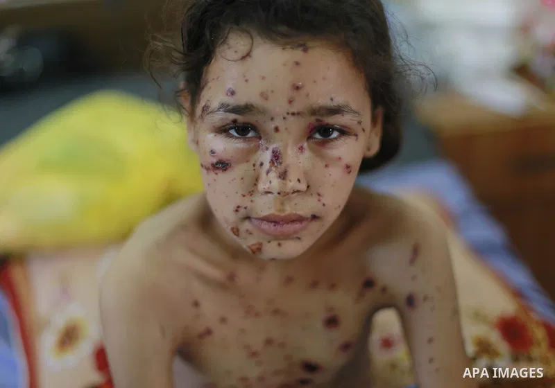 In this Sunday, August 03, 2014 photo, Palestinian children, rests at the Shifa hospital where they are receiving treatment for Injuries caused by Israeli shelling on neighborhoods in Gaza City .Photo by Ezz al-Zanoun