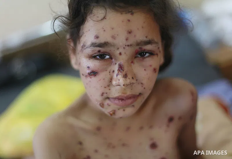 In this Sunday, August 03, 2014 photo, Palestinian children, rests at the Shifa hospital where they are receiving treatment for Injuries caused by Israeli shelling on neighborhoods in Gaza City .Photo by Ezz al-Zanoun