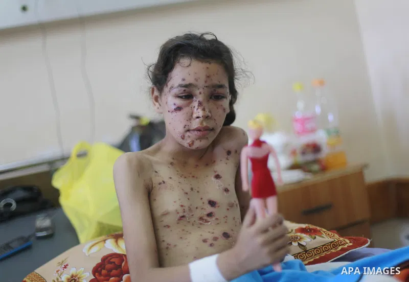 In this Sunday, August 03, 2014 photo, Palestinian children, rests at the Shifa hospital where they are receiving treatment for Injuries caused by Israeli shelling on neighborhoods in Gaza City .Photo by Ezz al-Zanoun