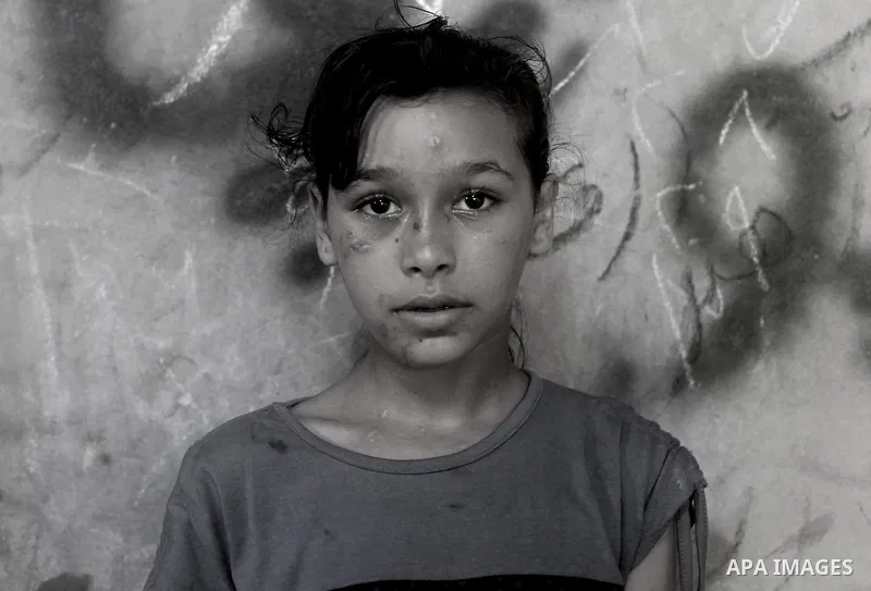 Dalia Khalifa, a Palestinian girl who was wounded during the recent Israeli bombardment of the Gaza Strip, waits to receive medical treatment at the al-Shifa hospital in Gaza City, on August 16, 2014. Israel and Palestin...