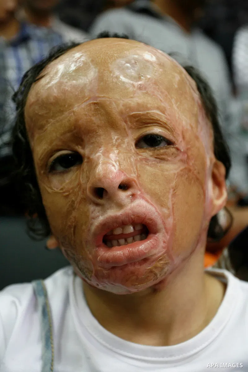 A Palestinian child, who medics said was wounded during the Israeli offensive on Gaza Strip, wait to be given the permission to cross into Egypt at the Rafah border crossing in the southern Gaza Strip, on Sep. 08, 2014....