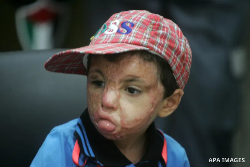 A Palestinian children, who medics said was wounded during the Israeli offensive on Gaza Strip, waits to be given the permission to cross into Egypt at the Rafah border crossing in the southern Gaza Strip, on Sep. 08, 20...