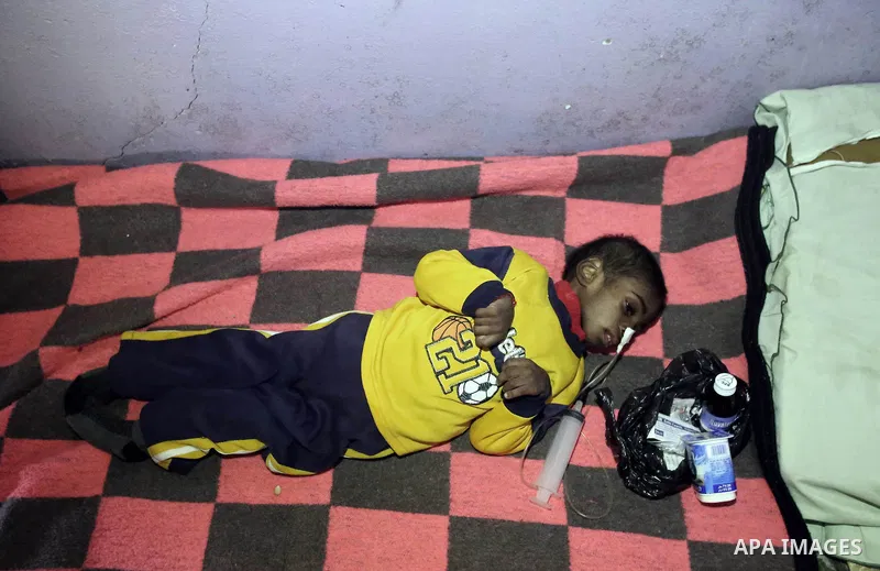 A photo taken on 30 January 2015 shows Jihad Al-Abeed, a 4-year-old Palestinian boy suffering from quadriplegia, lying on his bed at his family's tin shack, in Gaza city. Al-Abeed died days later because of not being abl...