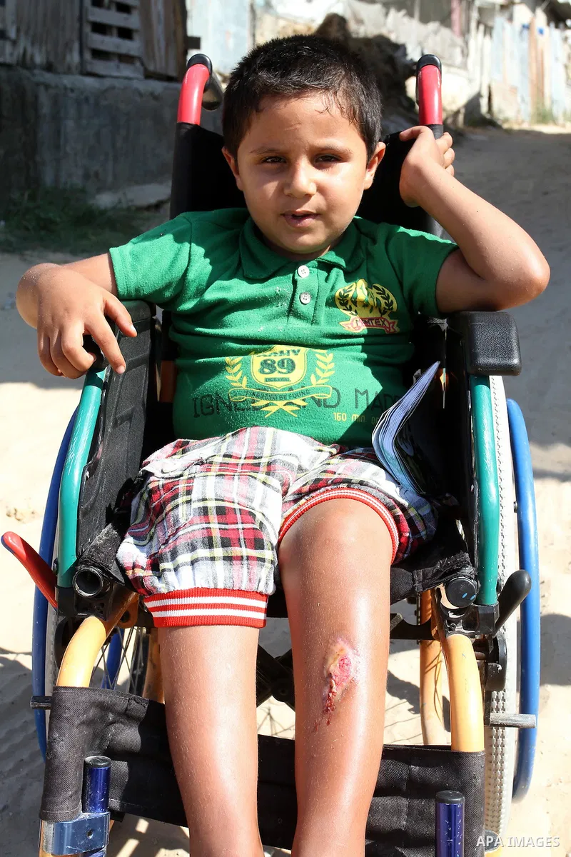 Palestinian boy Ayman Mahmoum, who was injured during the 50-day war between Israel and Hamas militants in the summer of 2014, sits on his wheelchair in a street in Rafah in the southern Gaza Strip on July 29, 2015. Ayma...