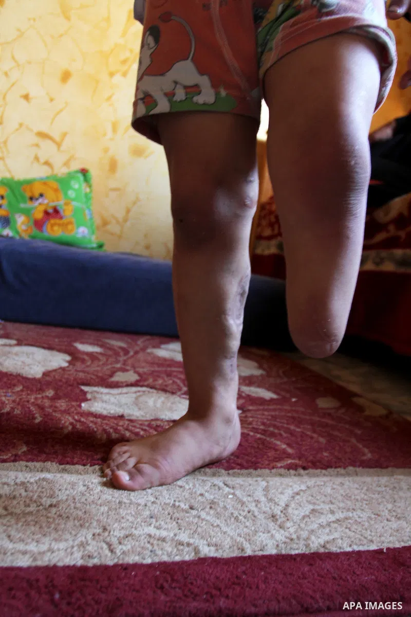 Palestinian child Sharif al-Namla who was injured during the 50-day war between Israel and Hamas militants in the summer of 2014, sits at his house on Feb. 28, 2016 in Rafah in the southern Gaza Strip. Wael al-Namla, 27,...