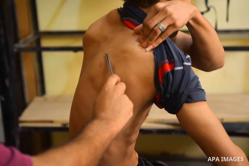 An Egyptian man places a bee on a man suffering from back problems so it can sting him at a centre in Cairo Out. 01, 2016. Photo by Amr Sayed