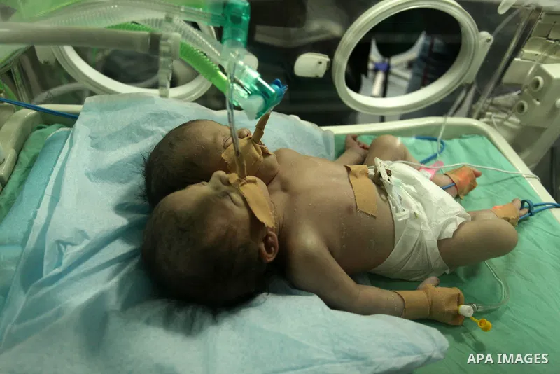 One-day-old Palestinian conjoined twin boys lie in an incubator at the nursery at al-Shifa Hospital in Gaza City on November 23, 2016. Photo by Ashraf Amra