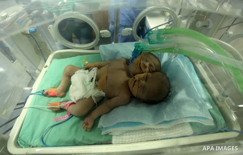 One-day-old Palestinian conjoined twin boys lie in an incubator at the nursery at al-Shifa Hospital in Gaza City on November 23, 2016. Photo by Ashraf Amra