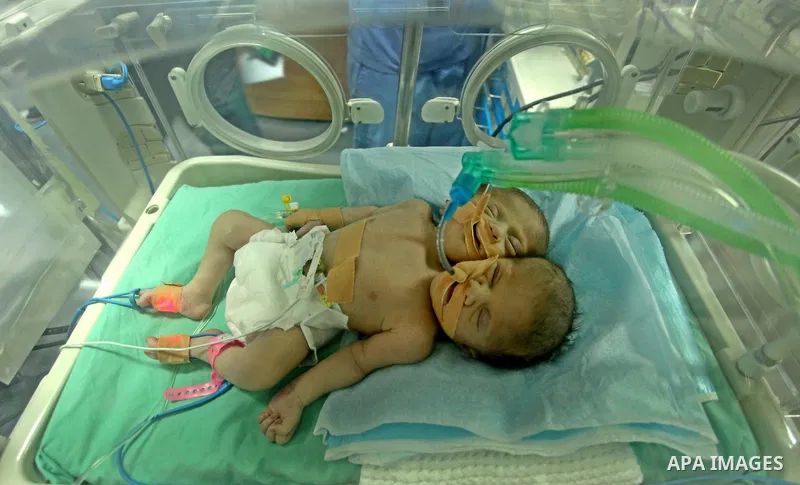 One-day-old Palestinian conjoined twin boys lie in an incubator at the nursery at al-Shifa Hospital in Gaza City on November 23, 2016. Photo by Ashraf Amra