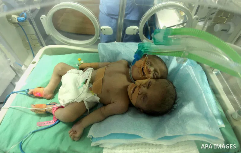 One-day-old Palestinian conjoined twin boys lie in an incubator at the nursery at al-Shifa Hospital in Gaza City on November 23, 2016. Photo by Ashraf Amra