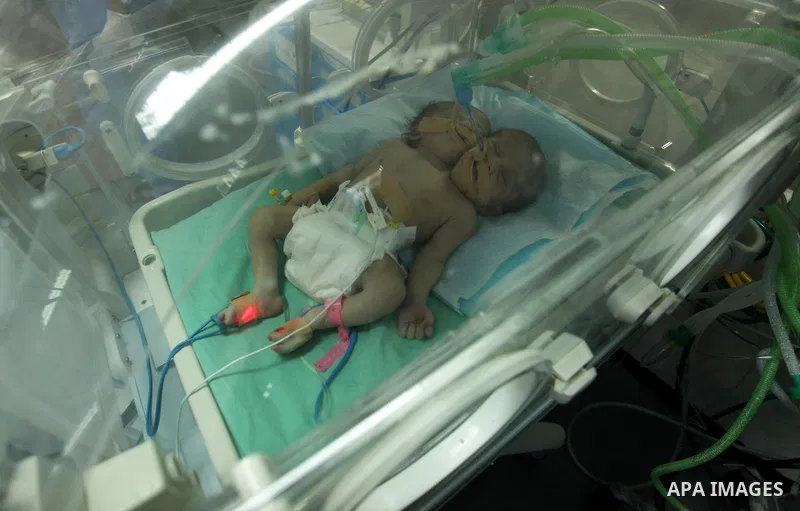 One-day-old Palestinian conjoined twin boys lie in an incubator at the nursery at al-Shifa Hospital in Gaza City on November 23, 2016. Photo by Ashraf Amra