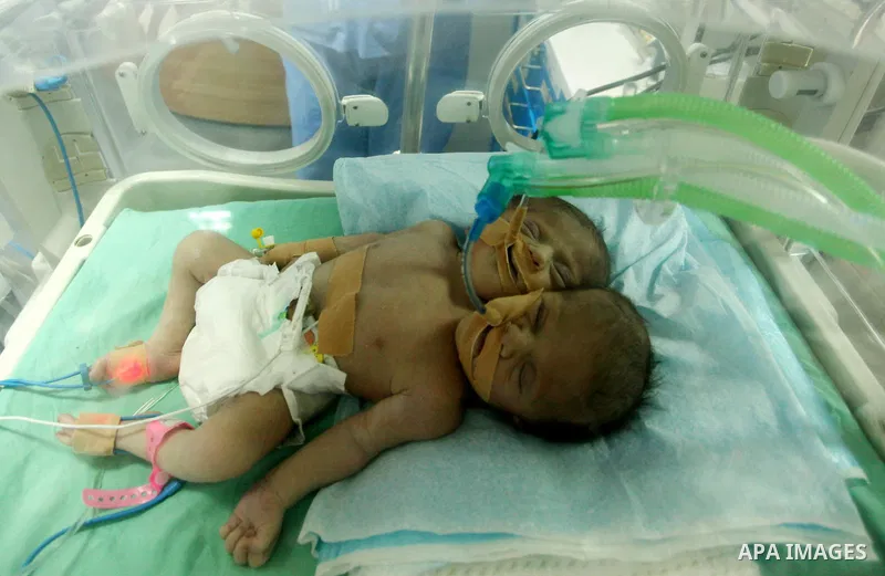 One-day-old Palestinian conjoined twin boys lie in an incubator at the nursery at al-Shifa Hospital in Gaza City on November 23, 2016. Photo by Ashraf Amra