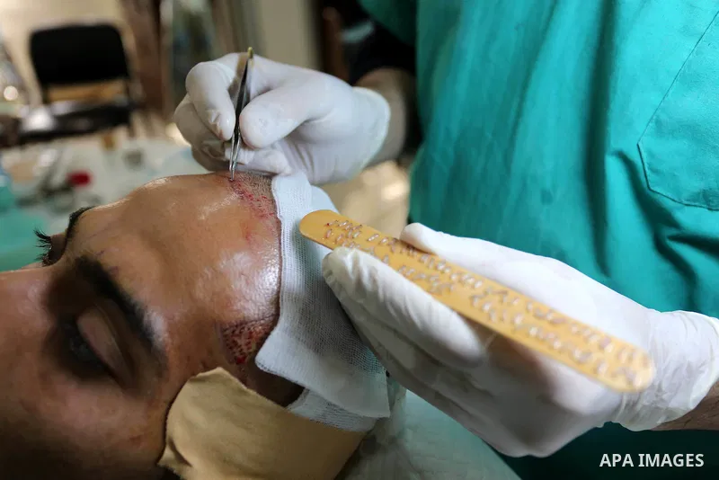 A Palestinian doctor Ahmed al-Moghrabi operates on a patient who undergo to Hair transplant surgery at his clinic, in Gaza city on February 28, 2018. Al-Moghrabi opened his clinic last year which is the first of its kind...