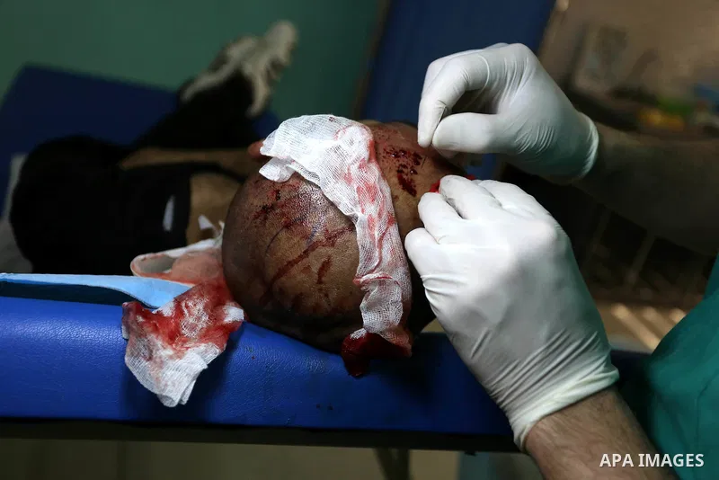 A Palestinian doctor Ahmed al-Moghrabi operates on a patient who undergo to Hair transplant surgery at his clinic, in Gaza city on February 28, 2018. Al-Moghrabi opened his clinic last year which is the first of its kind...