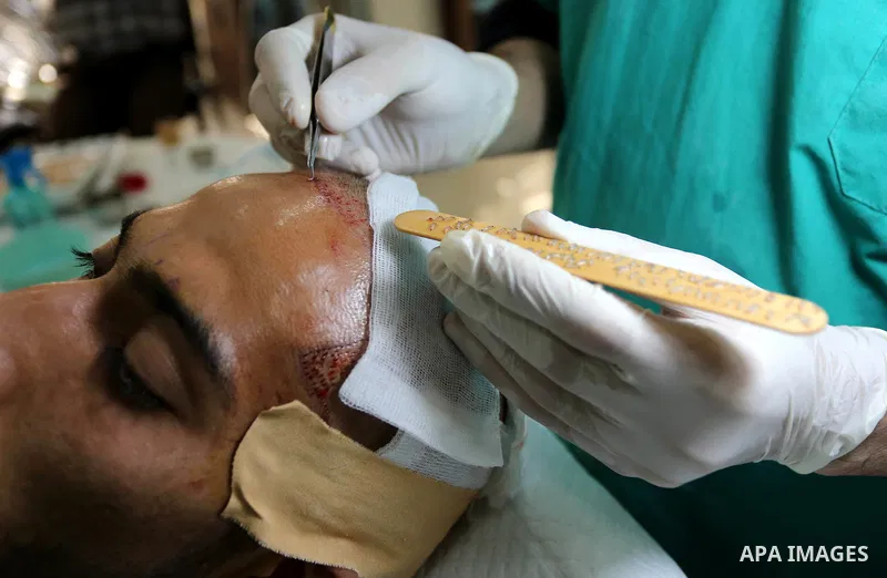 A Palestinian doctor Ahmed al-Moghrabi operates on a patient who undergo to Hair transplant surgery at his clinic, in Gaza city on February 28, 2018. Al-Moghrabi opened his clinic last year which is the first of its kind...