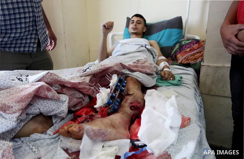 A Palestinian man who was wounded during clashes with Israeli security forces at Gaza-Israel border, lies on a bed to receive treatment at al-Shifa hospital in Gaza city on May 12, 2018. Photo by Mahmoud Ajour