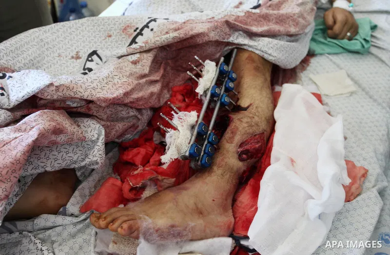 A Palestinian man who was wounded during clashes with Israeli security forces at Gaza-Israel border, lies on a bed to receive treatment at al-Shifa hospital in Gaza city on May 12, 2018. Photo by Mahmoud Ajour